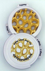 Bone Osteoporosis Disk Set OpenedPharmaceutical and Anatomical Model Gifts